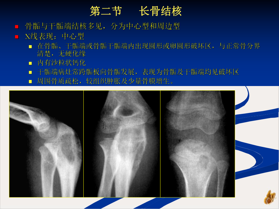 骨关节结核课件.pptx_第3页