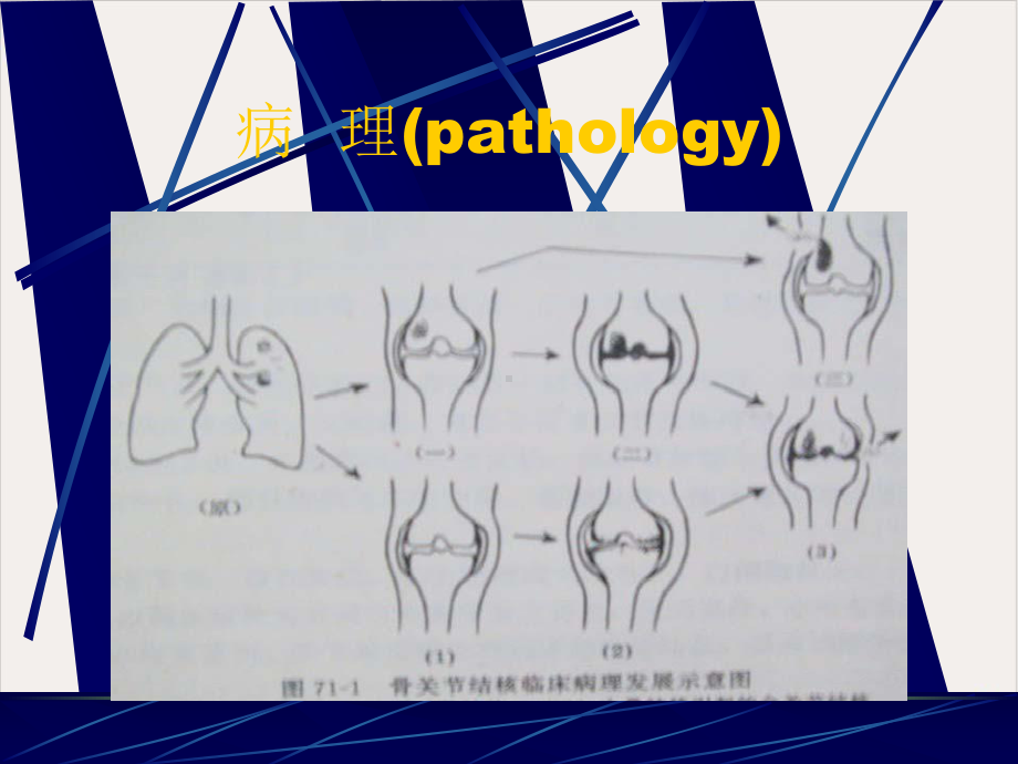 骨与关节结核教学课件.pptx_第2页