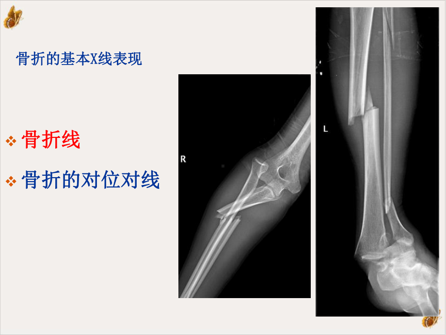 骨骼与关节损伤培训课件.pptx_第2页