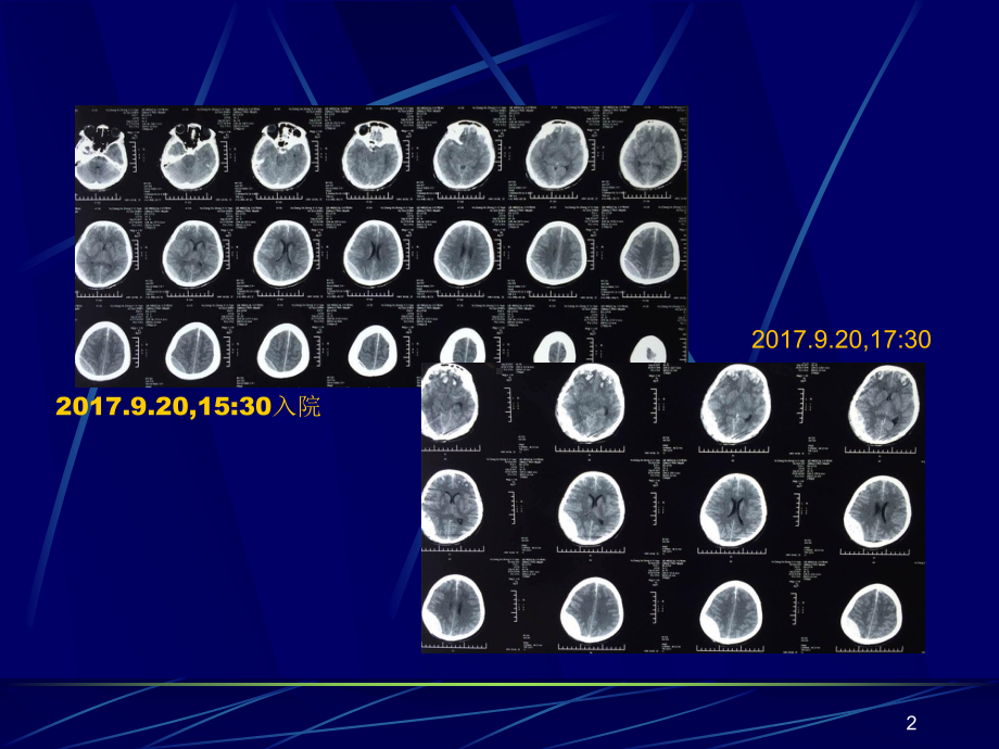颅内出血后脑水肿的管理课件.ppt_第2页