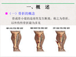 骨折后护理课件.pptx