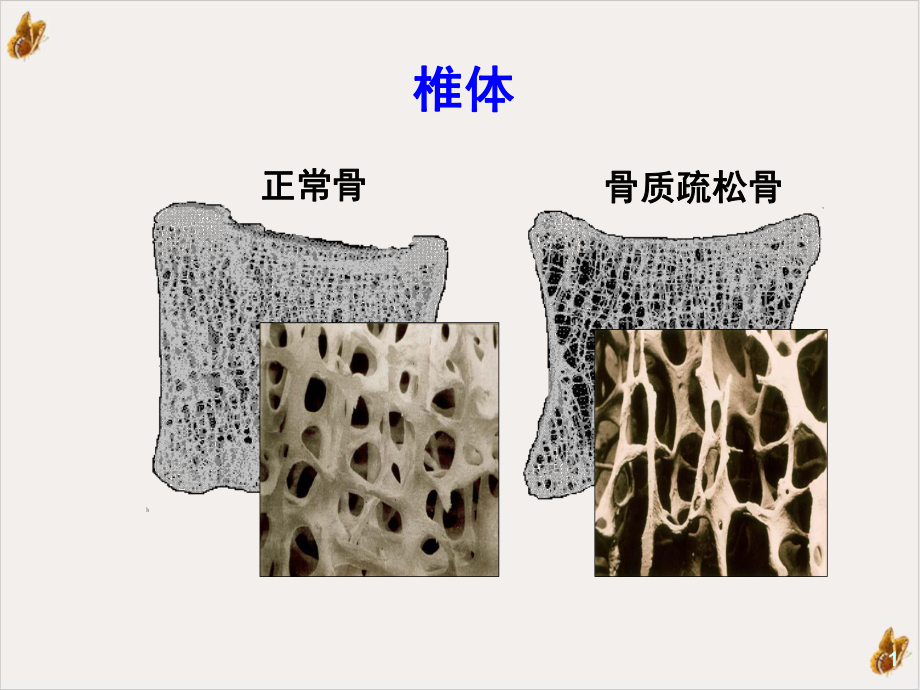 骨质疏松规范诊疗教材课件.pptx_第1页