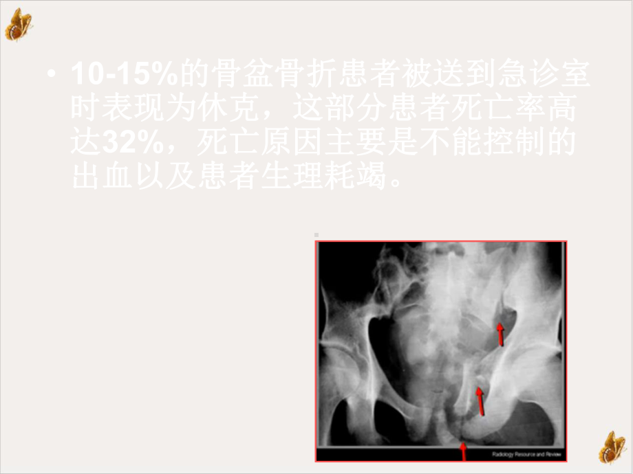 骨盆骨折的处理指南教材课件.pptx_第3页