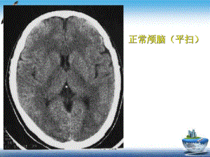 颅脑CT诊断和读片技巧课件.pptx