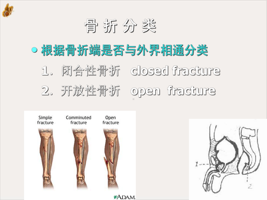 骨折病人的护理及康复指导课件.pptx_第3页