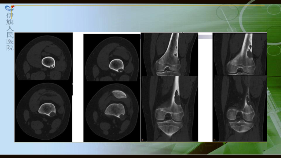 非骨化纤维瘤影像诊断1课件.ppt_第2页