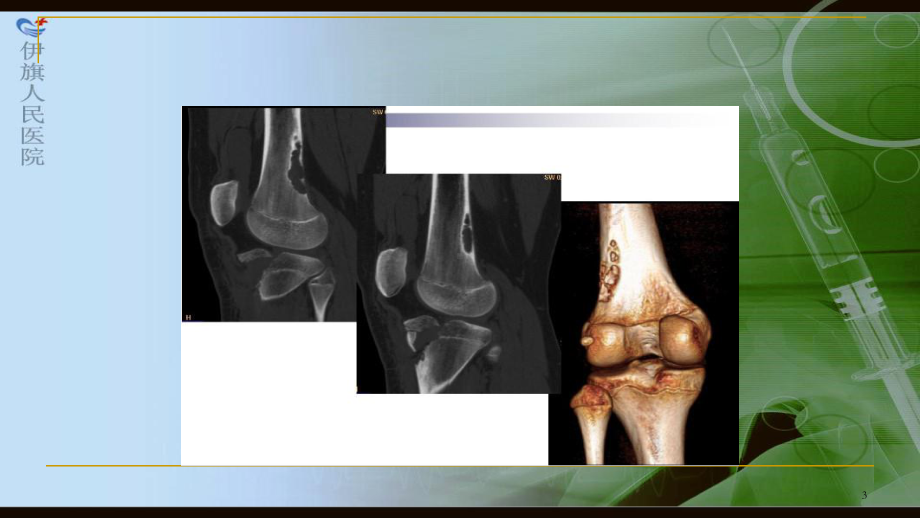 非骨化纤维瘤影像诊断1课件.ppt_第3页