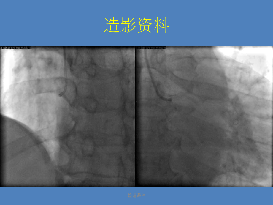 山重水复疑无路前降支慢闭塞介入治疗一例课件.ppt_第3页