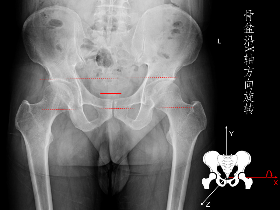 髋关节X线片测量角度课件.ppt_第3页