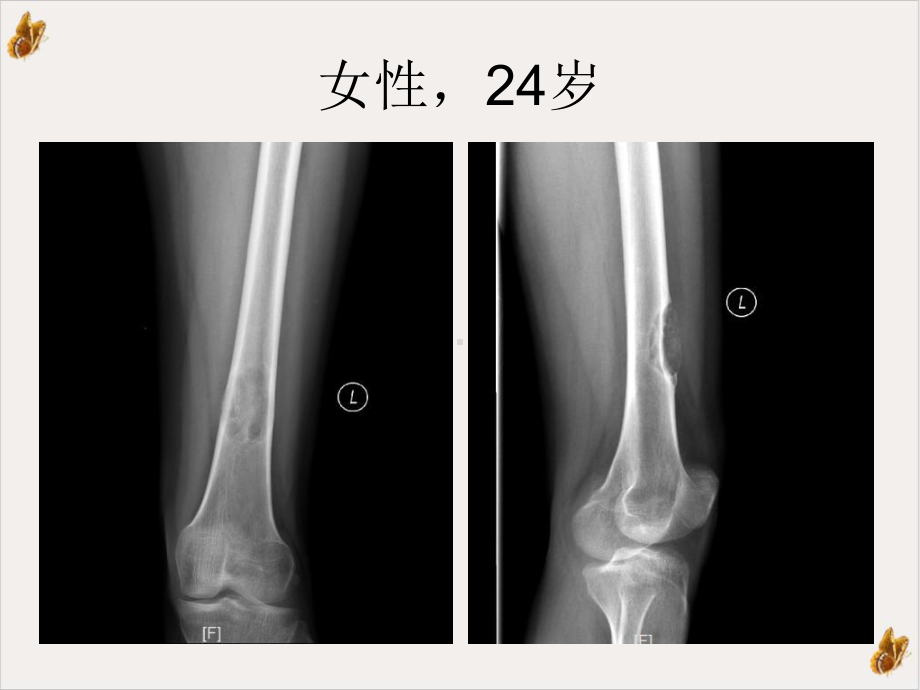 软骨粘液样纤维瘤的x线诊断及鉴别诊断课件.pptx_第2页