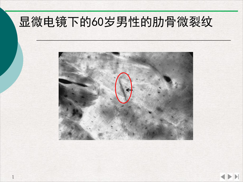 骨质疏松性骨折处理原则实用版课件.pptx_第2页