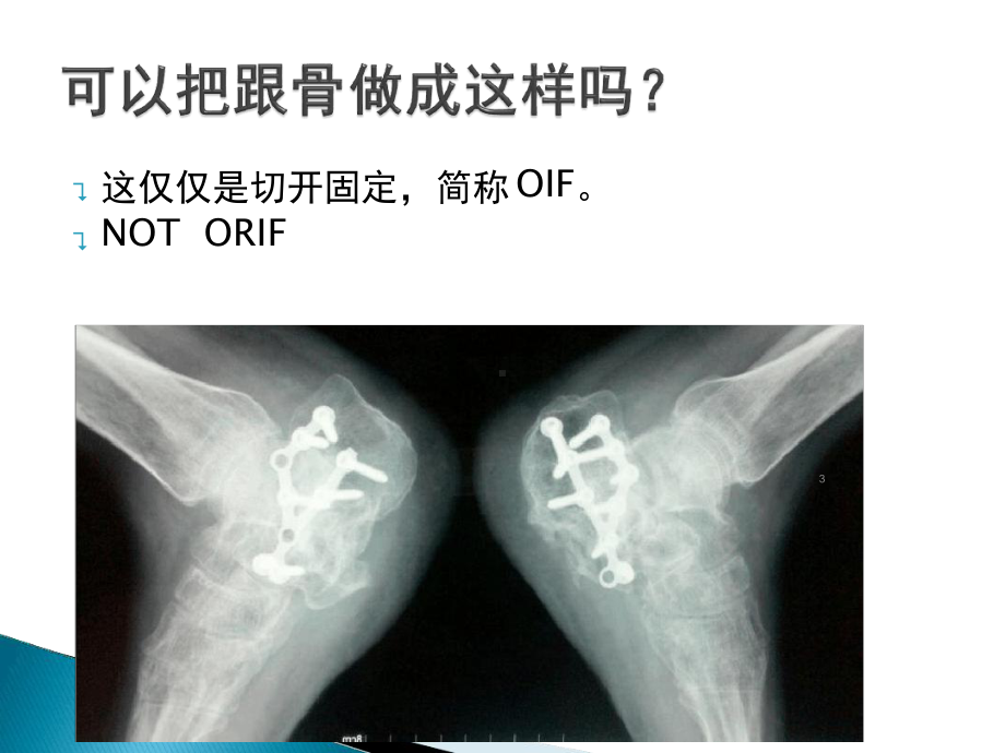 跟骨手术治疗技巧课件整理.ppt_第3页