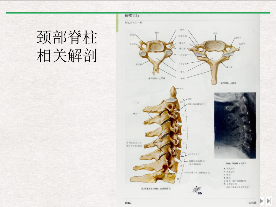 颈椎病的MRI诊断课件完整版.ppt_第2页