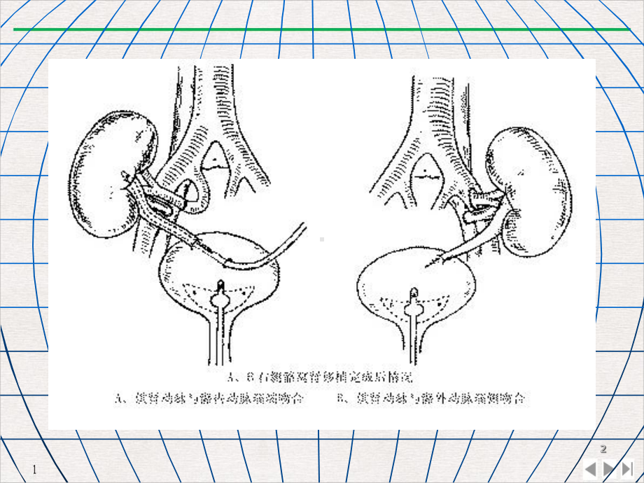 超强资料临床麻醉学器官移植手术麻醉课件.pptx_第2页