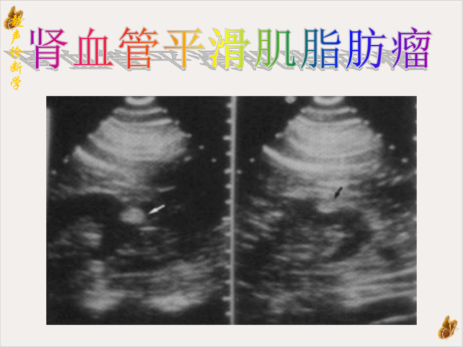 超声诊断肾炎结石外伤肿瘤课件.pptx_第1页