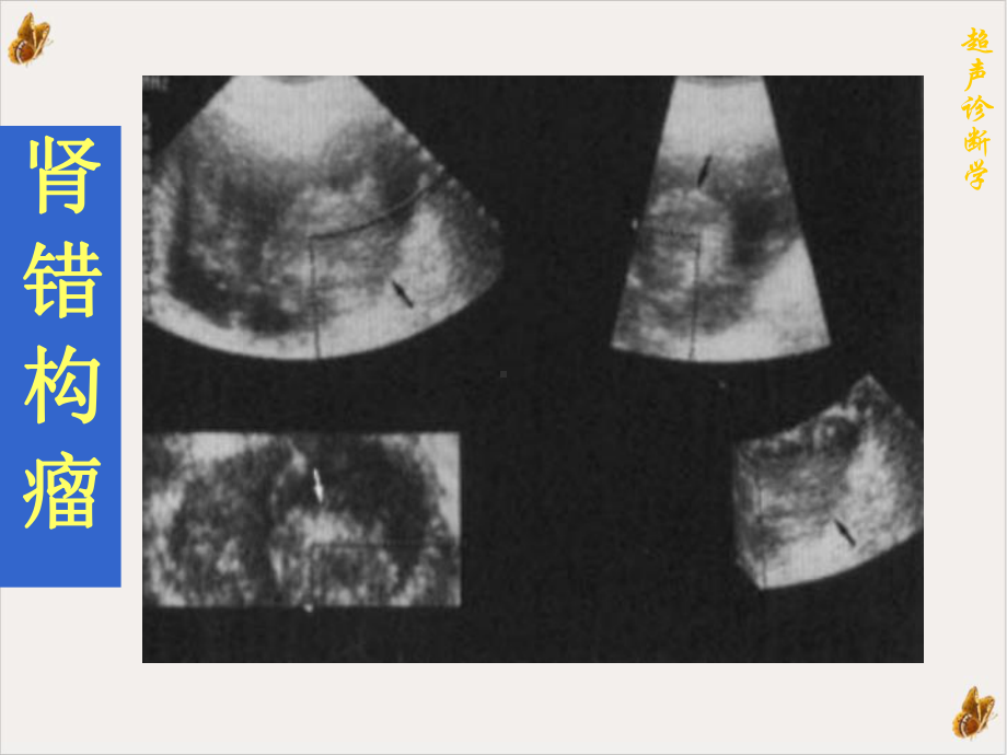 超声诊断肾炎结石外伤肿瘤课件.pptx_第3页