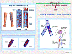 静脉血栓症的实验室诊断完整版课件.pptx
