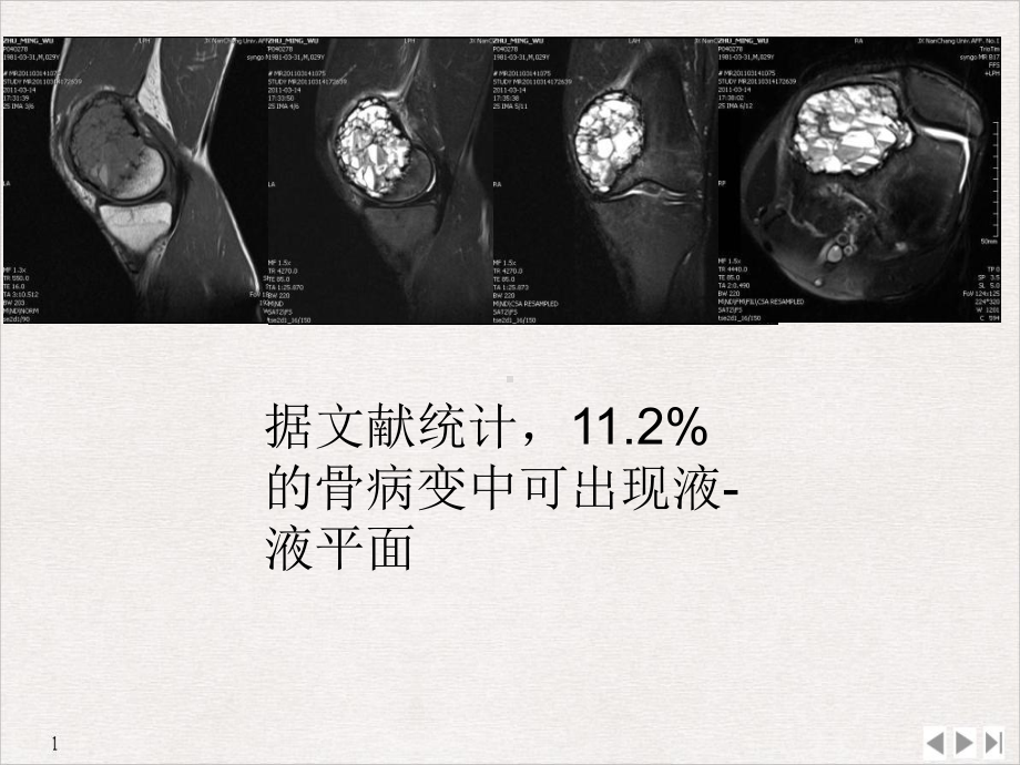 骨与软组织病变液液平面影像诊断价值教学课件.pptx_第1页