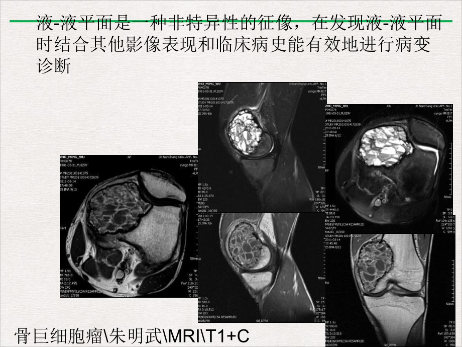 骨与软组织病变液液平面影像诊断价值教学课件.pptx_第2页