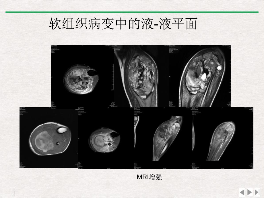 骨与软组织病变液液平面影像诊断价值教学课件.pptx_第3页