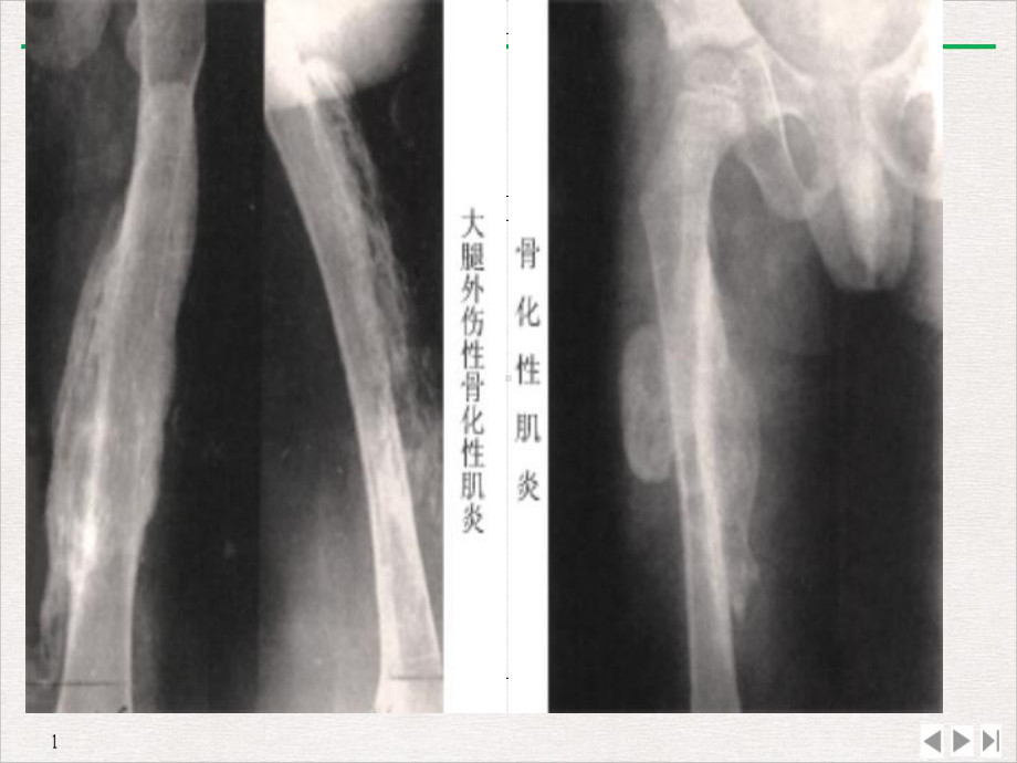 骨化性肌炎精选课件.ppt_第3页