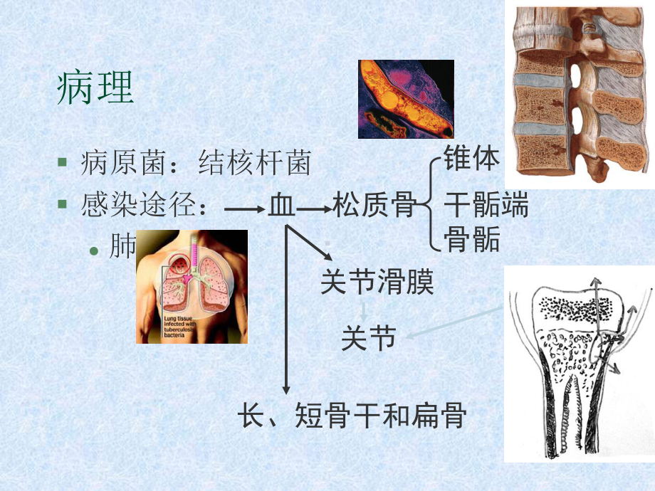 骨关节结核课件(同名228).ppt_第2页