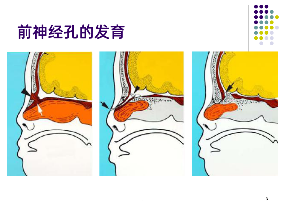 鼻根肿物的鉴别诊断课件.ppt_第3页