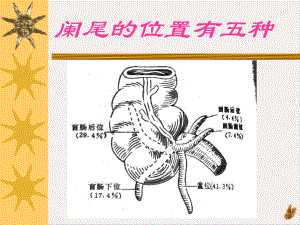 阑尾炎病人的护理本科培训课件.pptx