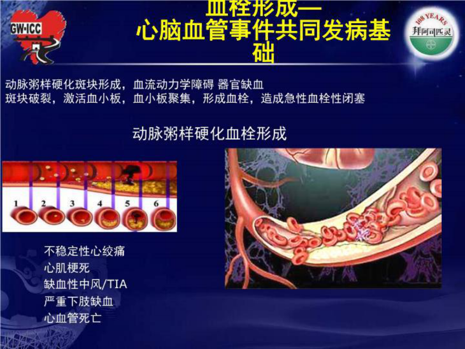 最新从8指南看糖尿病抗血小板治疗课件.ppt_第3页