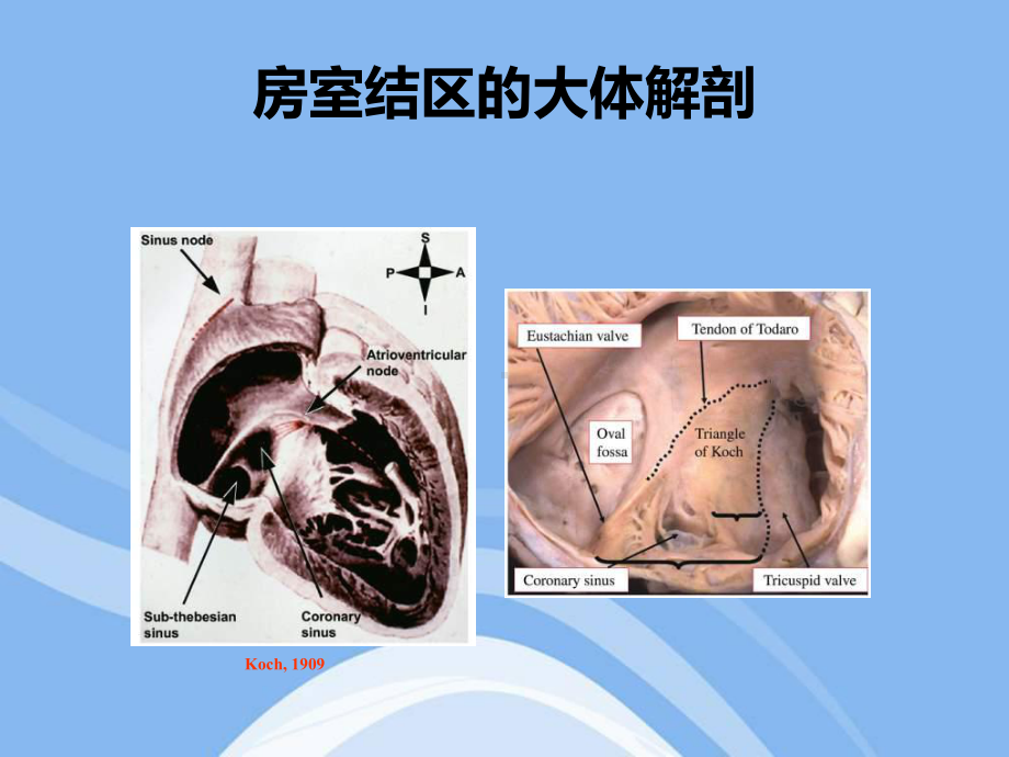 房室结双径路传导的基本电生理特征与常见心电图表现分析课件.ppt_第2页