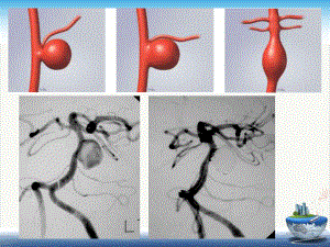 颅内动脉瘤周良课件.pptx