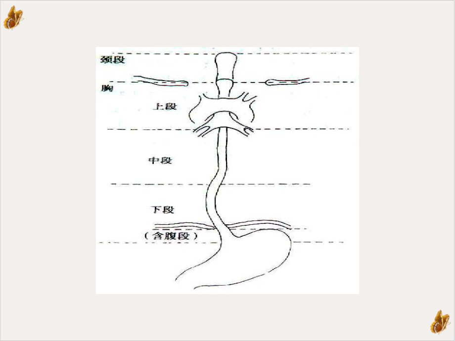 食管癌术后吻合口瘘的护理课件.pptx_第2页