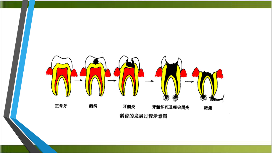 龋齿的治疗课件.pptx_第3页