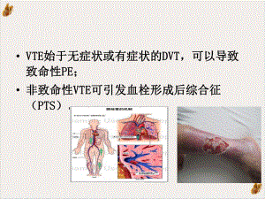 静脉血栓栓塞症预防培训课程课件.pptx