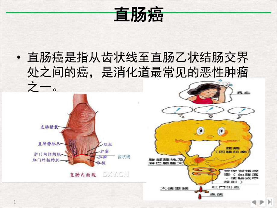 教学查房直肠癌围手术期护理课件.ppt_第3页