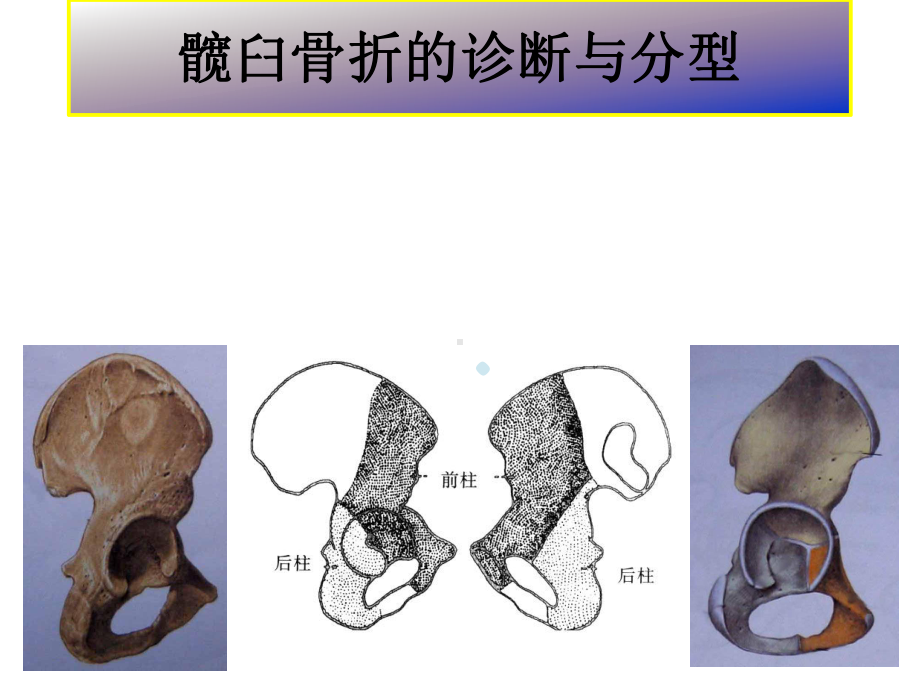 髋臼骨折基础知识课件整理.pptx_第2页