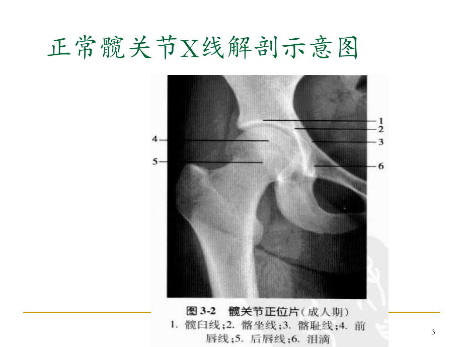 髋关节测量课件.ppt_第3页