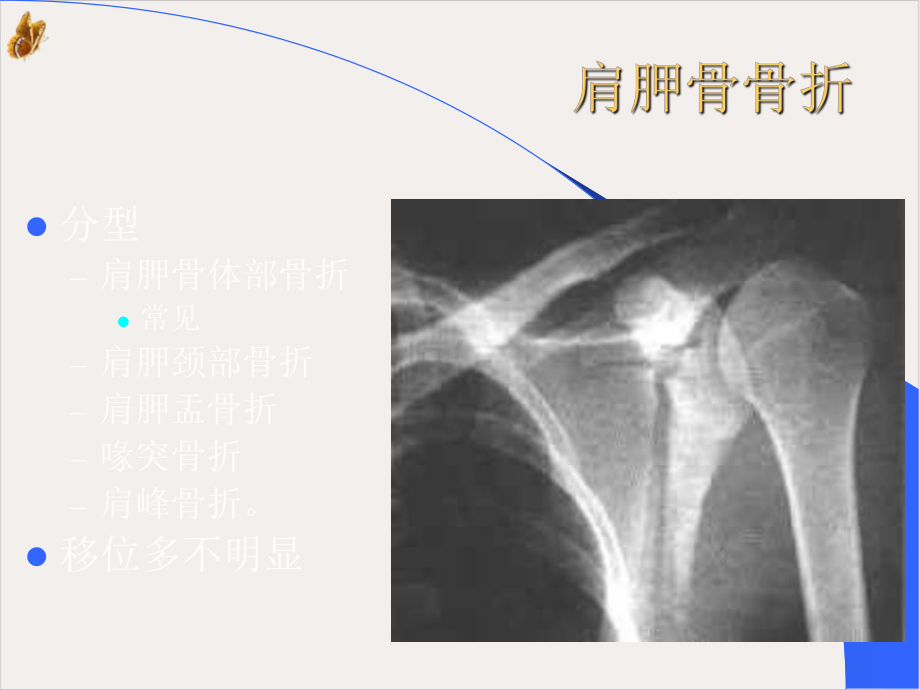 骨科X线片教学课件.pptx_第3页