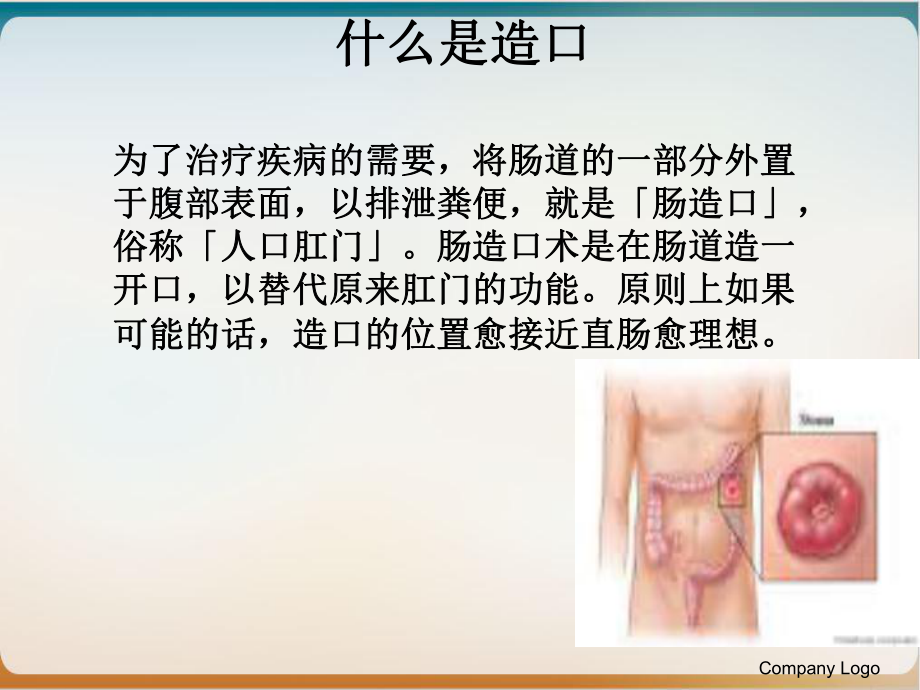 造口护理流程课件1.ppt_第3页