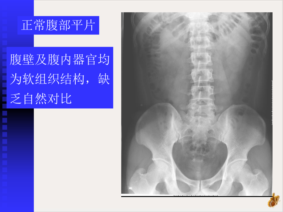 青年医生影像系列急腹症影像学课件.pptx_第3页