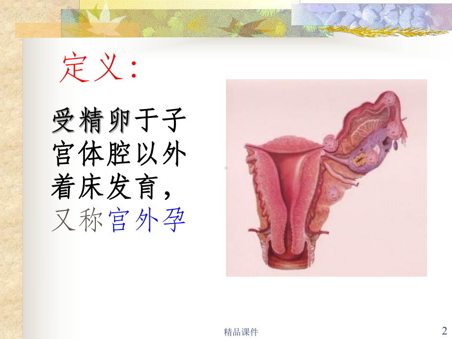 宫外孕的护理(同名602)课件.ppt_第2页