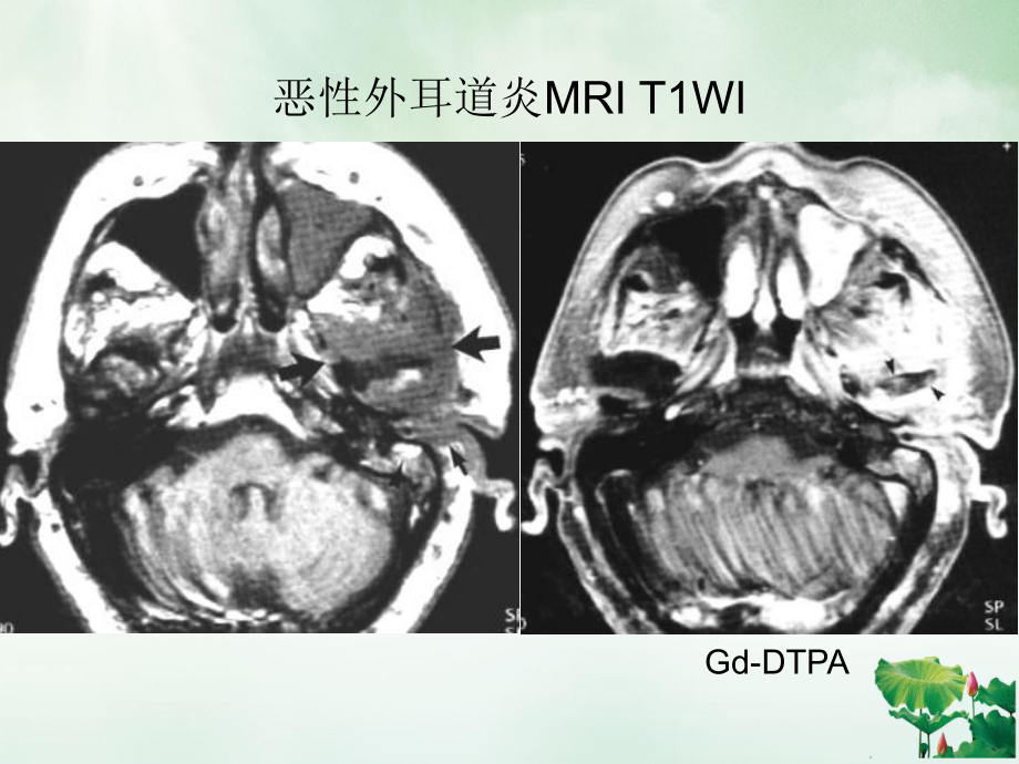 颞骨与耳部炎症及并发症同仁放射课件.ppt_第2页