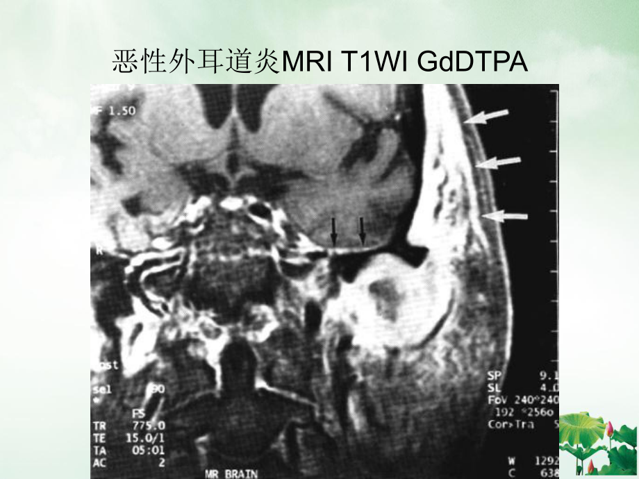 颞骨与耳部炎症及并发症同仁放射课件.ppt_第3页