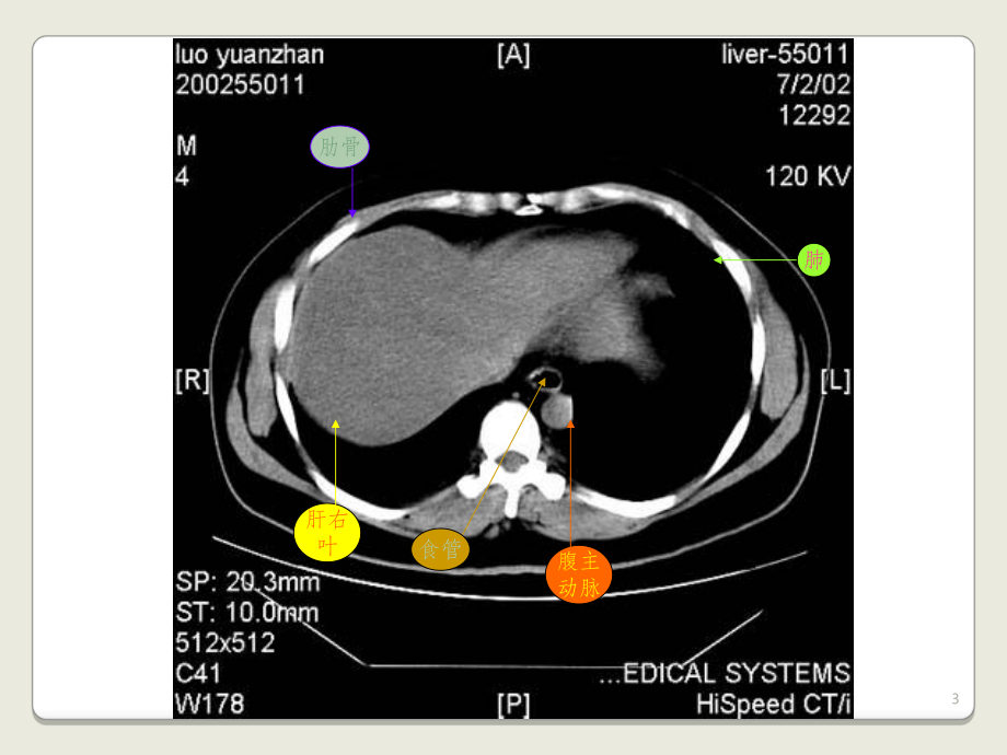 上腹部CT基础图解课件.ppt_第3页