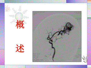 颅内动静脉畸形的治疗与护理课件.pptx