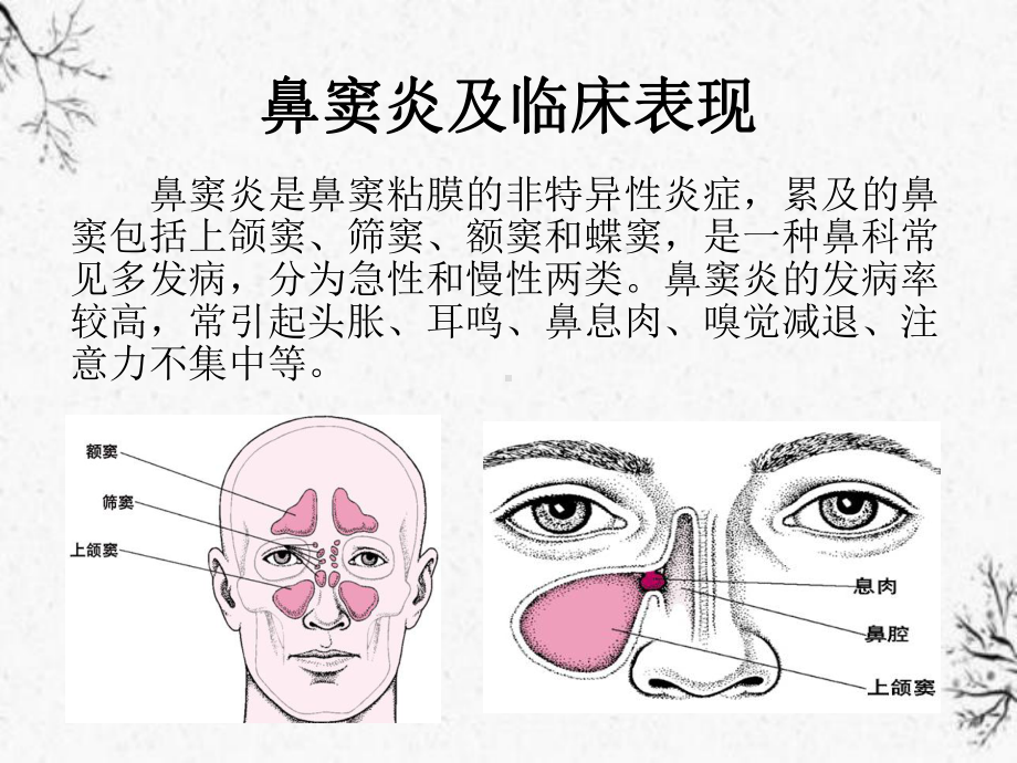 鼻窦炎护理闸中心年(最新版)课件.ppt_第3页