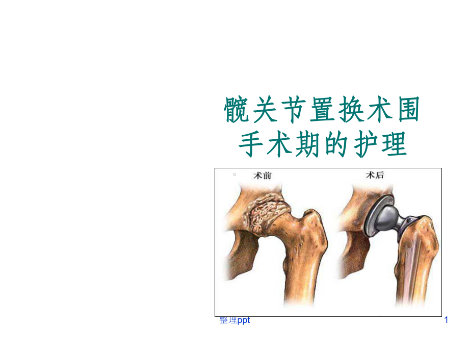 髋关节置换术围手术期的护理课件.ppt_第1页