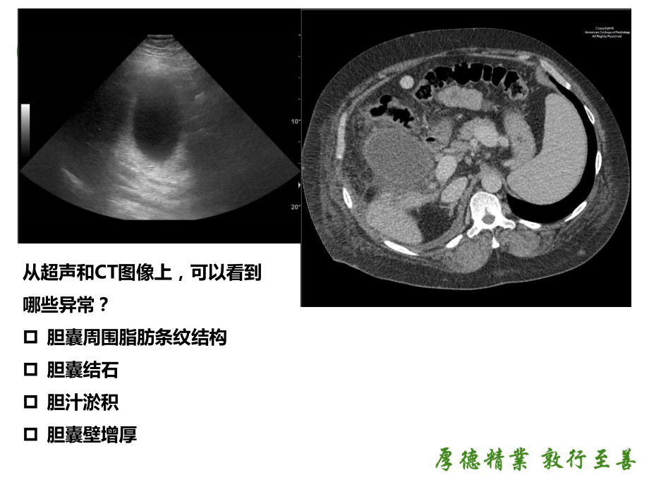 急性无结石型胆囊炎影像学表现课件.pptx_第3页