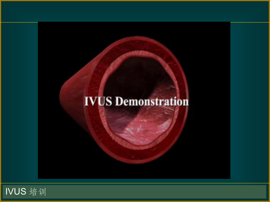 IVUS-血管内超声基础和临床课件.ppt_第2页