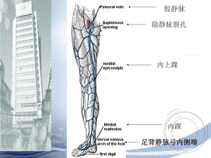 大隐静脉曲张课件.ppt